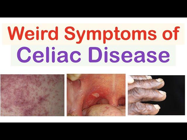 Weird Symptoms of Celiac Disease | Atypical Clinical Features