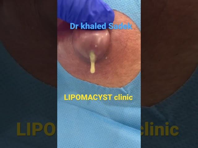 Massive infected cyst #blackheads #shorts #skincare Dr Khaled Sadek LIPOMACYST clinic