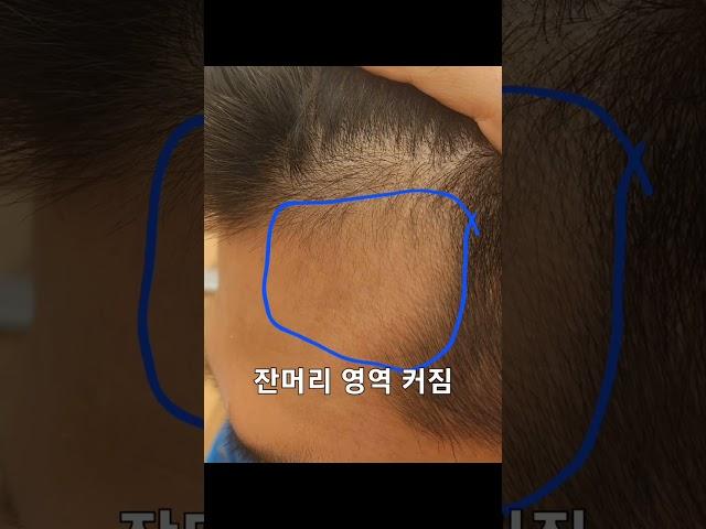 M자탈모 극복 동기부여영상