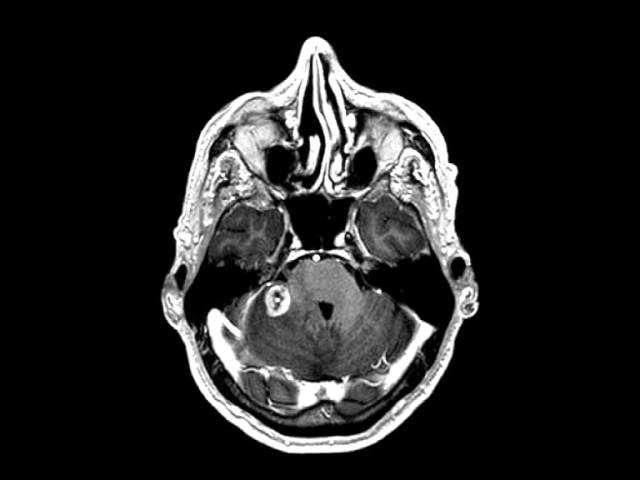 CEREBELLAR METASTASIS - SERVICIO NEUROCIRUGÍA UNIDAD DE RAQUIS - HUMV