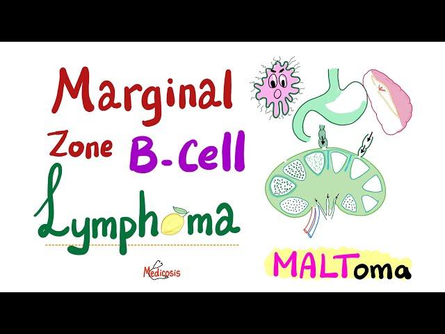 Marginal Zone B-Cell lymphoma (MALToma) - Indolent B-Cell Non-Hodgkin’s Lymphoma - Hematology/ Onco