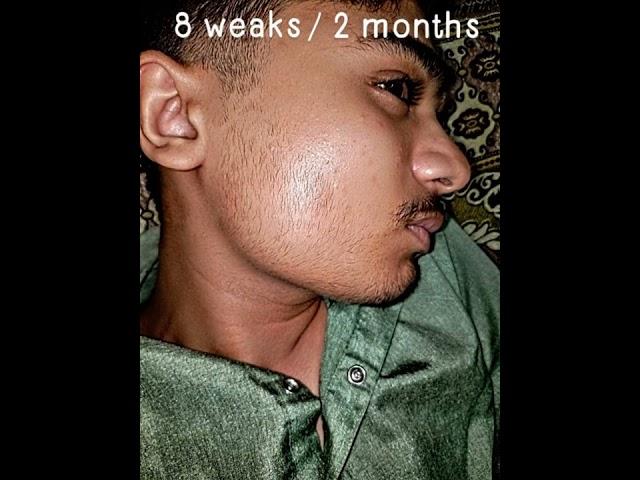 My Minoxidil 5% Journey: Shocking Before and After Transformation Revealed #minoxidil5