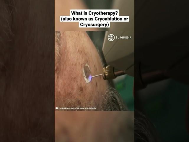 What is Cryotherapy (also known as Cryoablation or Cryosurgery)?