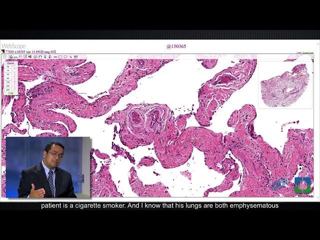 Pathology Insights: Atypical Epithelial Cells with Sanjay Mukhopadhyay, MD