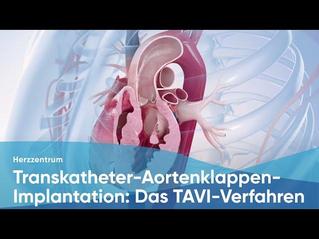 Transkatheter-Aortenklappen-Implantation: Das TAVI-Verfahren