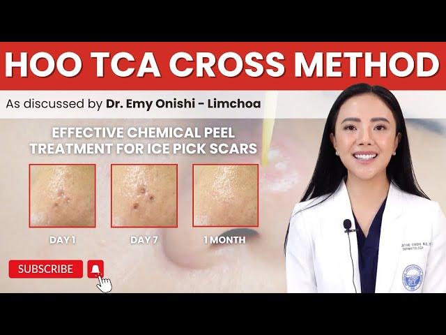 TCA CROSS METHOD FOR ICE PICK SCARS