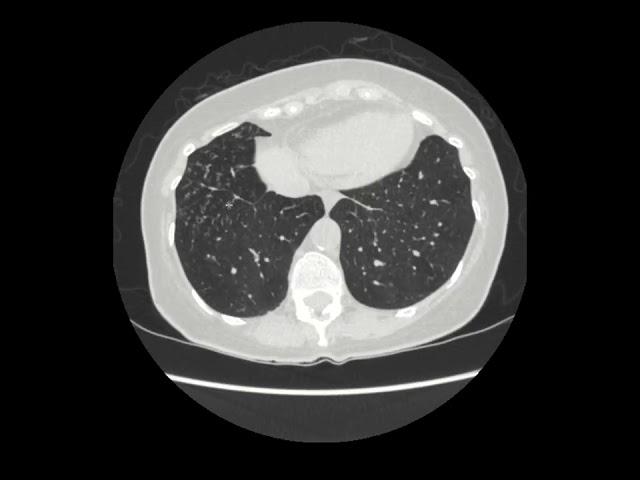 Pulmonary MAC infection