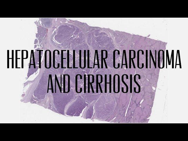 12  hepatocellular carcinoma and cirrhosis
