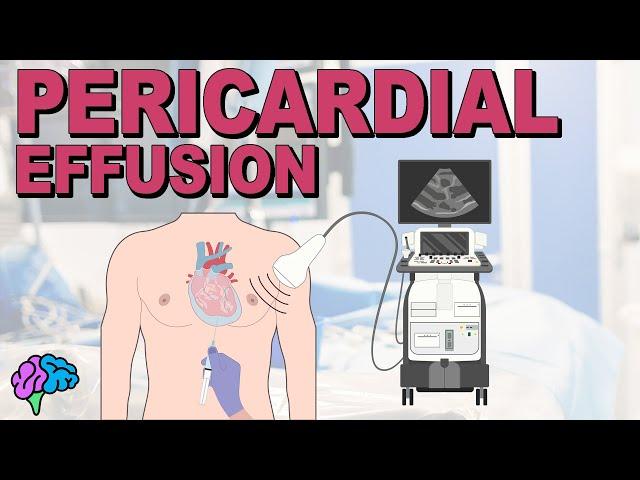 Pericardial Effusion EXPLAINED: What You Need to Know to Recognize, Understand and Treat It!