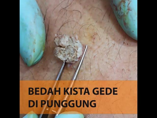 Kista di Punggung