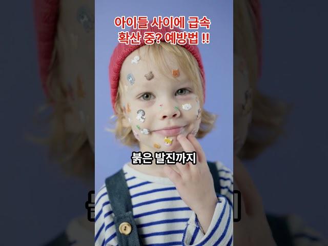 지금 아이들에게  급속 확산! #전염병 # 예방하기 #10세#성홍열