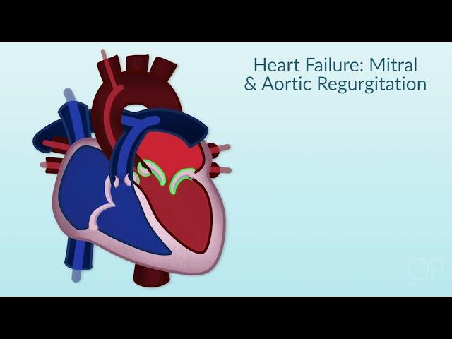 Rheumatic Heart Disease by E. Rusingiza | OPENPediatrics