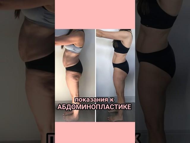 Абдоминопластика ️ https://seoulguidemedical.com/ #абдоминопластика #пластикавкорее