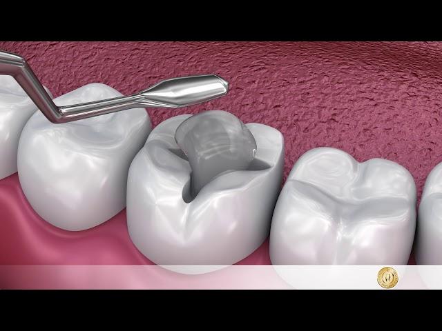 Dentistry: Removal of caries