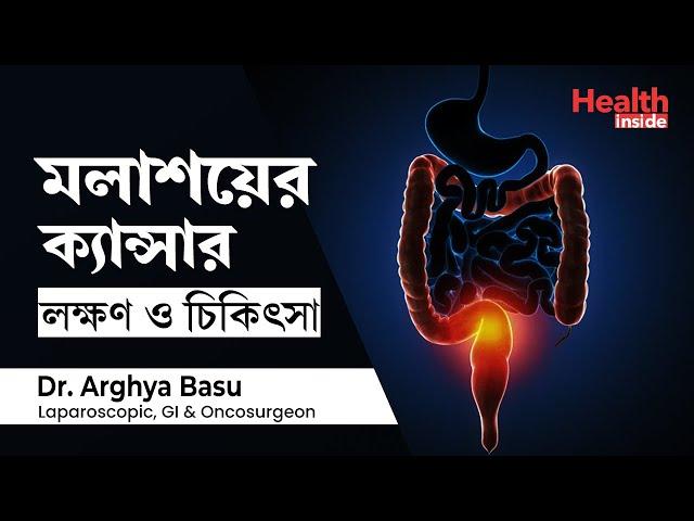 মলদ্বার এবং মলাশয় এর ক্যান্সারের লক্ষণ ও চিকিৎসা | Rectal cancer Symptoms,  diagnosis and Treatment