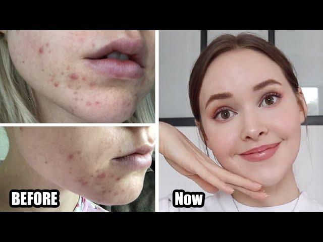 How To Really Get Rid Of Acne (& texture/acne scars/skin damage) *Adult Hormonal Acne*