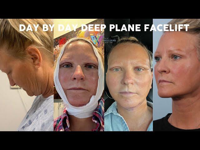 Day by Day Deep Plane Facelift Recovery (6 weeks post-op)