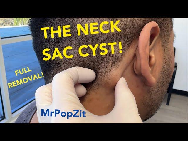 The neck sac cyst.Full removal of contents and sac. 6 week follow up at the end . See how it healed!