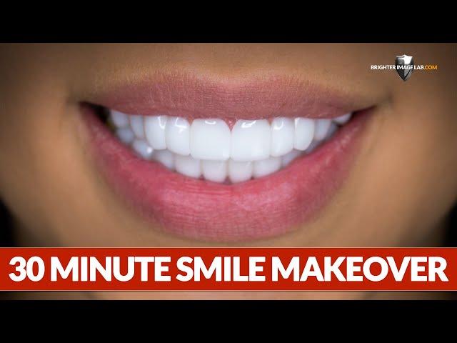 Dental Veneers - This Smile Makeover Took 30 Minutes by Brighter Image Lab!