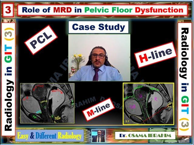 3 MR Defecography ( its role in pelvic floor dysfunction)