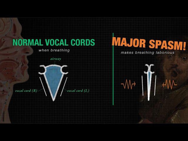 Respiratory Dystonia | When Spasms Affect the Voice