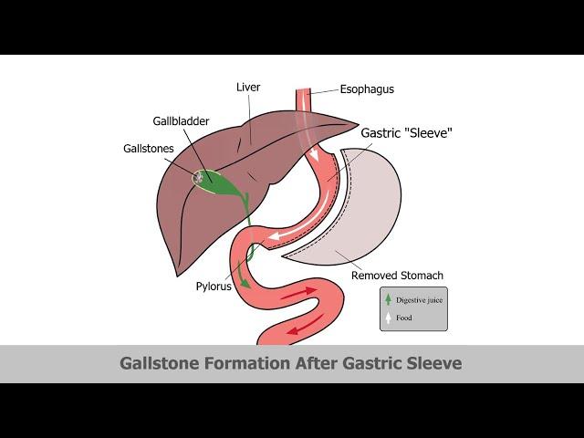 LAPAROSCOPIC CHOLECYSTECTOMY FOLLOWING BARIATRIC SURGERY (POST MGB)