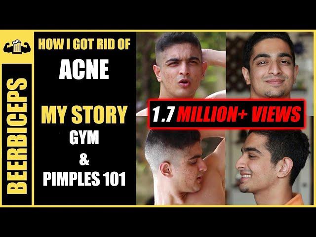 Goodbye Forever ACNE - Pimples Treatment 101 | BeerBiceps Acne & Fitness