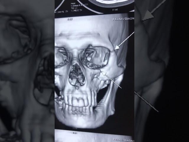 Nerve decompression to correct Cheek Paresthesia following facial fractures