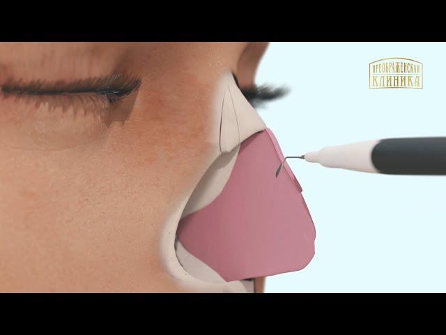 Ринопластика. Пластика носа. Пьезо-ринопластика. 3D-анимация хода операции.