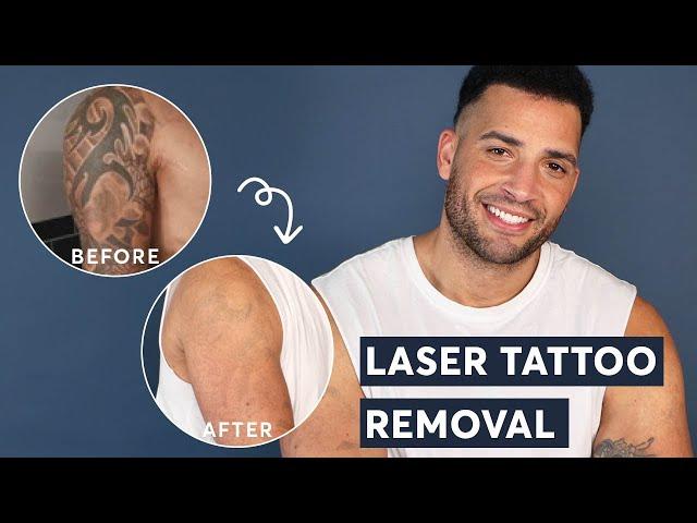Laser Tattoo Removal - FULL ARM Tattoo Update after 3 treatments