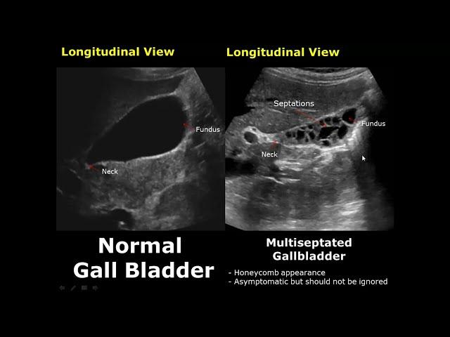 Gallbladder Ultrasound Normal Vs Abnormal Image Appearances Comparison | Gallbladder Pathologies USG