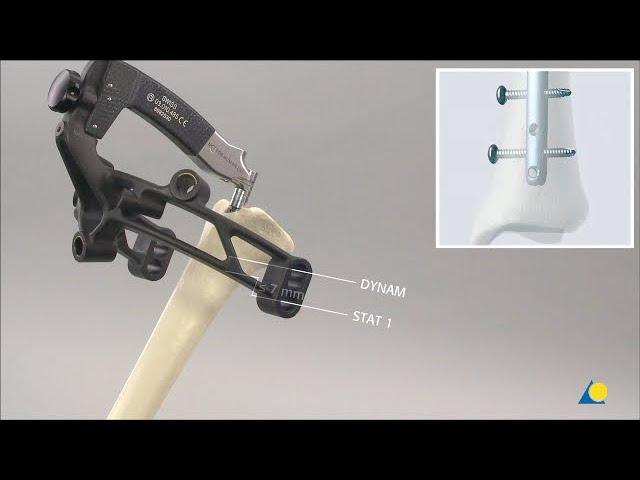 Tibia, Shaft - Fracture - Closed Reduction and Reamed Intramedullary Nailing Using the ETN