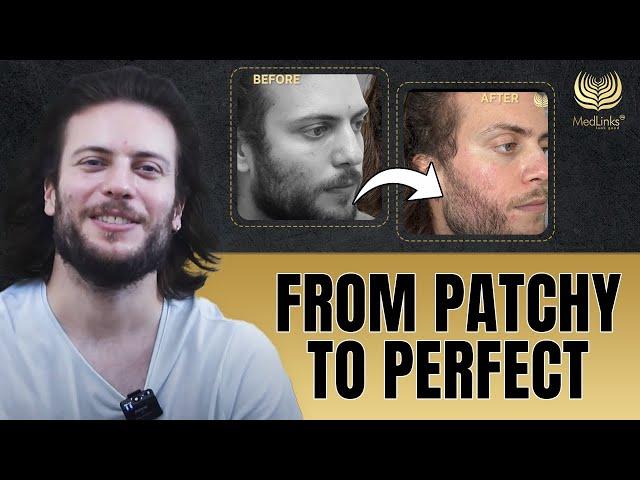 Unbelievable Beard Hair Transplant Results | MedLInks