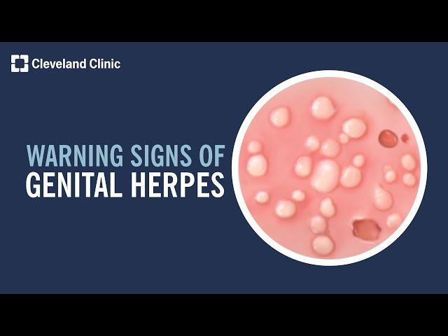 5 Warning Signs of Genital Herpes