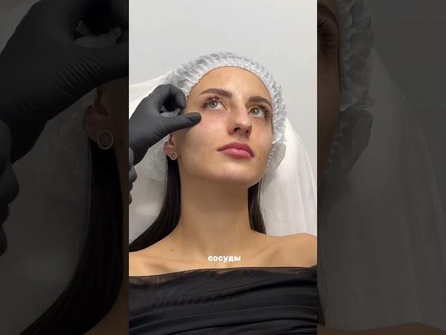Как убрать темные круги под глазами? #контурнаяпластика #сферогель #темныеукруги #рекомендации