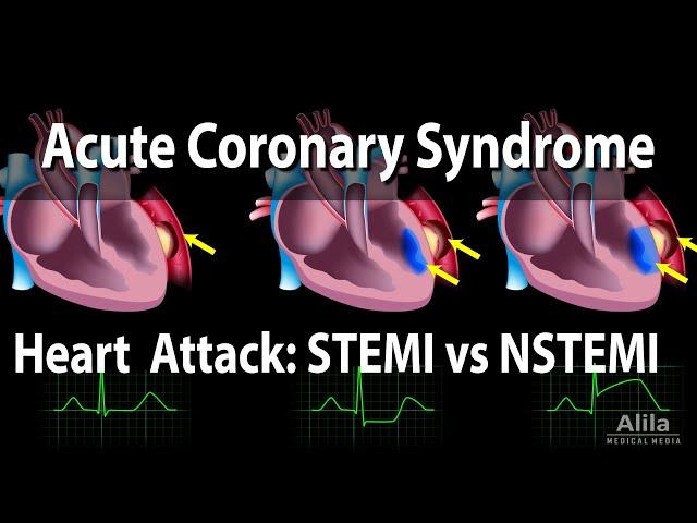 Acute Coronary Syndrome: Unstable Angina, NSTEMI and STEMI (Heart Attack), Animation