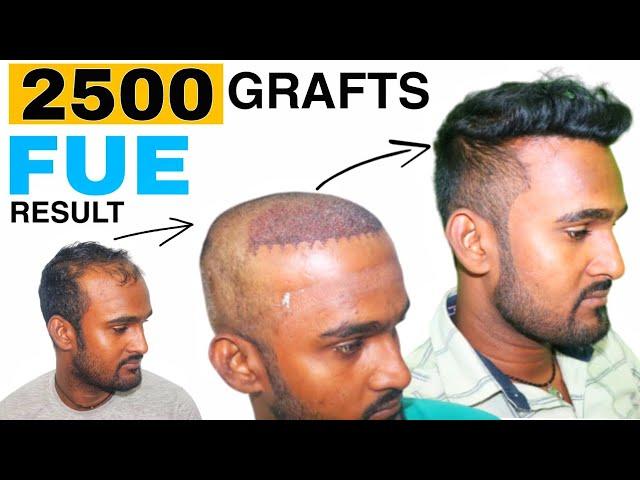 Hair Transplant Result of 28 Year Old Young Male || 2500 Grafts FUE || Regrow Clinic Haridwar