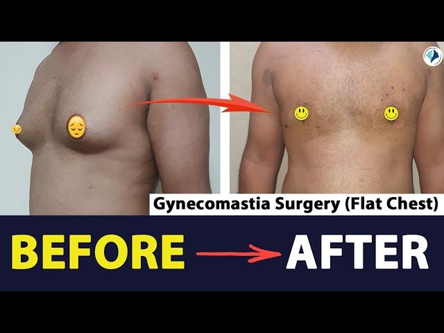 Gynecomastia Surgery Before After Results After 10 Days | Gynecomastia Surgery Before After Results