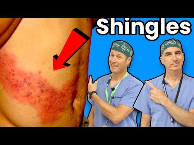 Shingles - You Definitely Don't Want This!