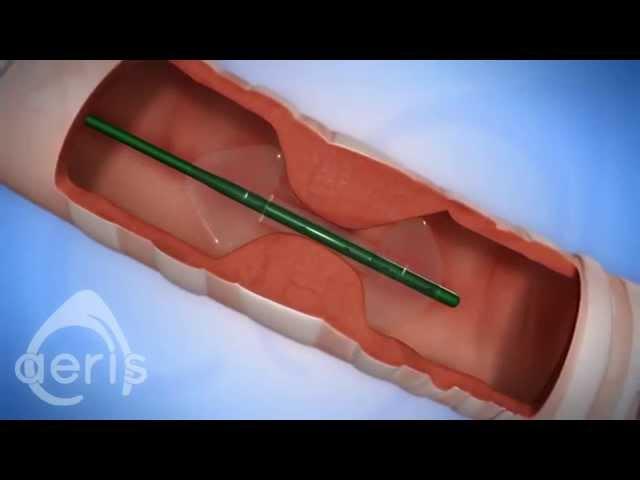 Introducing aeris, a balloon catheter for treatment of airway stenosis