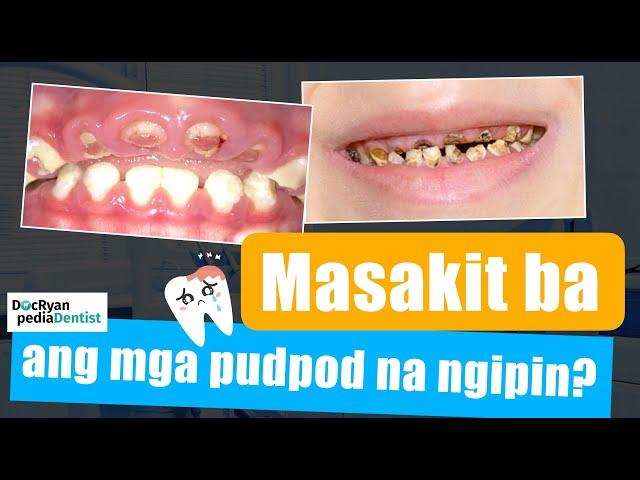 MASAKIT BA ang PUDPOD NA NGIPIN sa mga bata?