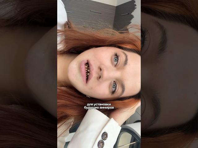 Мне сточили зубы?🫢 #стоматология #виниры #турция #анталья #блог #лайф #простовита