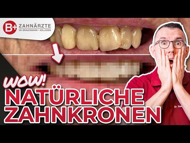 Neues Lächeln mit 6 Zahn Kronen - Smile Makeover Oberkiefer - inklusive Vorher / Nachher!