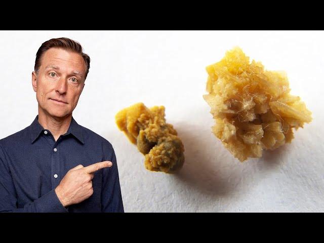 The Deeper Cause of Kidney Stones You've Never Heard About