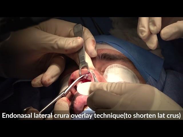 Endonasal Lat Crura Overlay Technique-11/991:Rhinoplasty Bizrah- London/Dubai- Dr Bashar Bizrah