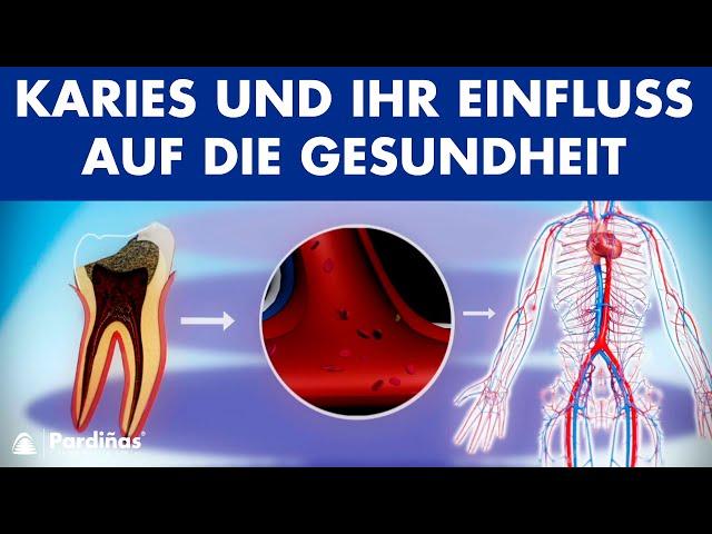 Karies und ihr Einfluss auf die Gesundheit ©