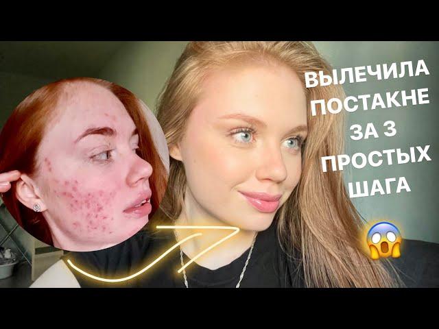 Как убрать постакне / Как убрать пятна от прыщей / Эффективные способы лечения постакне