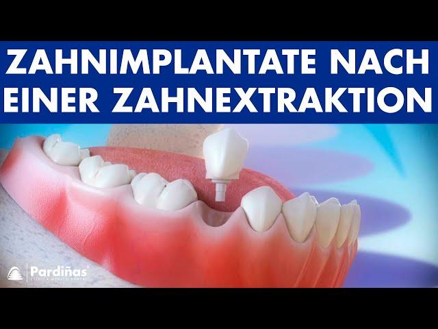 Zahnimplantate nach einer Zahnextraktion ©