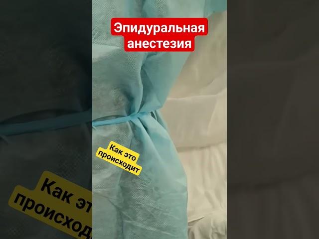 Эпидуральная анестезия