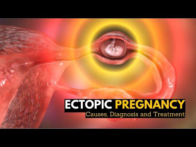 Ectopic Pregnancy, Causes, Signs and Symptoms, Diagnosis and Treatment.